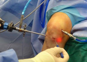 How Total Knee Arthroplasty Can Improve Your Quality of Life