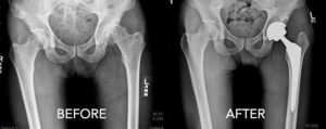What to Expect Before, During, and After Hip Replacement Surgery